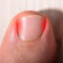 Pieds Bonheur ongle incarné