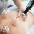 Cupping & Stretching – 60 min